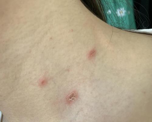 猫咪感染艾滋病的症状及防治方法（猫咪感染艾滋病的关键症状与预防措施）
