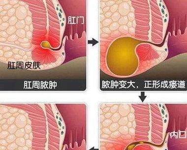 了解狗狗肛瘘——预防、症状和治疗（详细解析狗狗肛瘘的症状、治疗方法和预防措施）