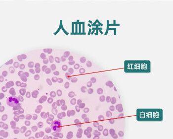 红血球高白血球底的病因与治疗（探讨红血球高白血球底的疾病类型及其治疗方法）