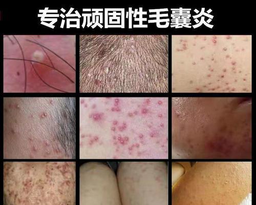 寄生虫性皮肤病大揭秘（了解寄生虫性皮肤病的症状、传播途径及治疗方法）