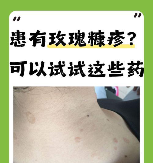 了解常见的治疗皮肤病药物（掌握药物类型和应用指南）