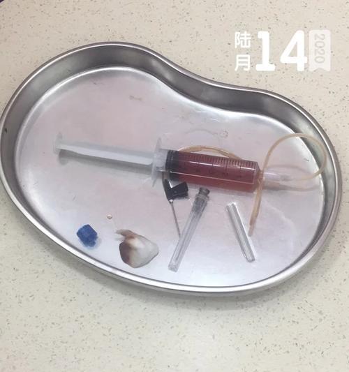耳血肿恢复时间及关键因素解析（探讨耳血肿恢复周期与相关治疗方法）